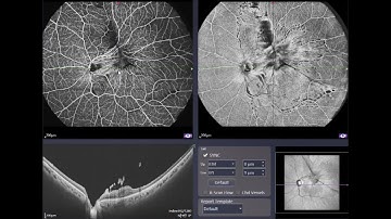 Epiretinal membrane "waves" fly through in 120° OCTA single scan by TowardPi BMizar 400KHz SS-OCT