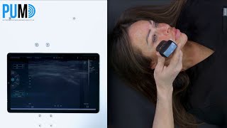 Scanning for dermal filler with the ScanX Air