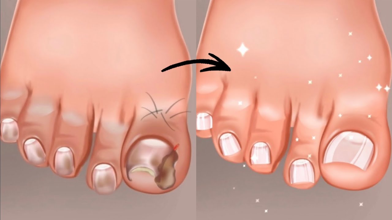ASMR Coolness Alert! Realistic Ingrown Toenail Care GameGameplay 