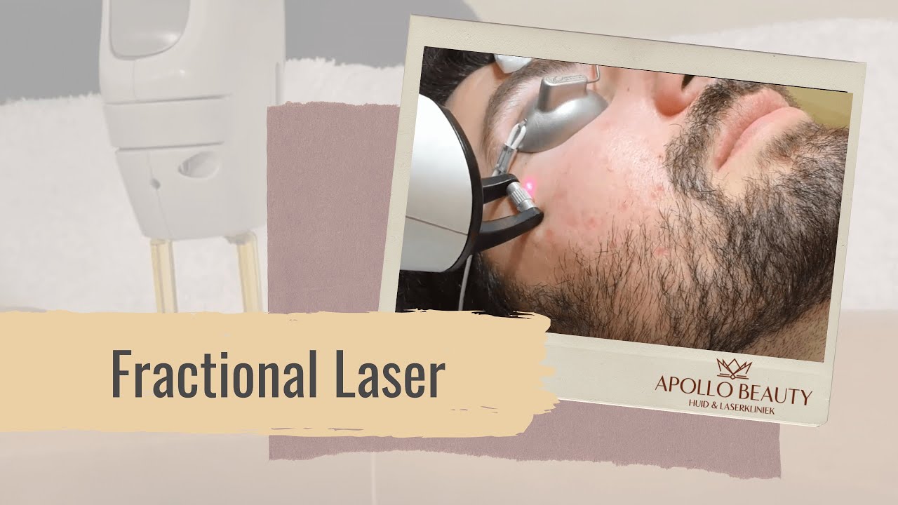 Fractional laserbehandeling acne