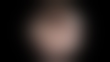 Draf III. The Outside-in Endoscopic modified Lothrop procedure.