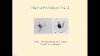Thyroid Cancer - CRASH! Medical Review Series