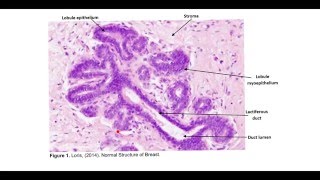 Invasive Ductal Carcinoma - Cellular Pathology (Practical 4)