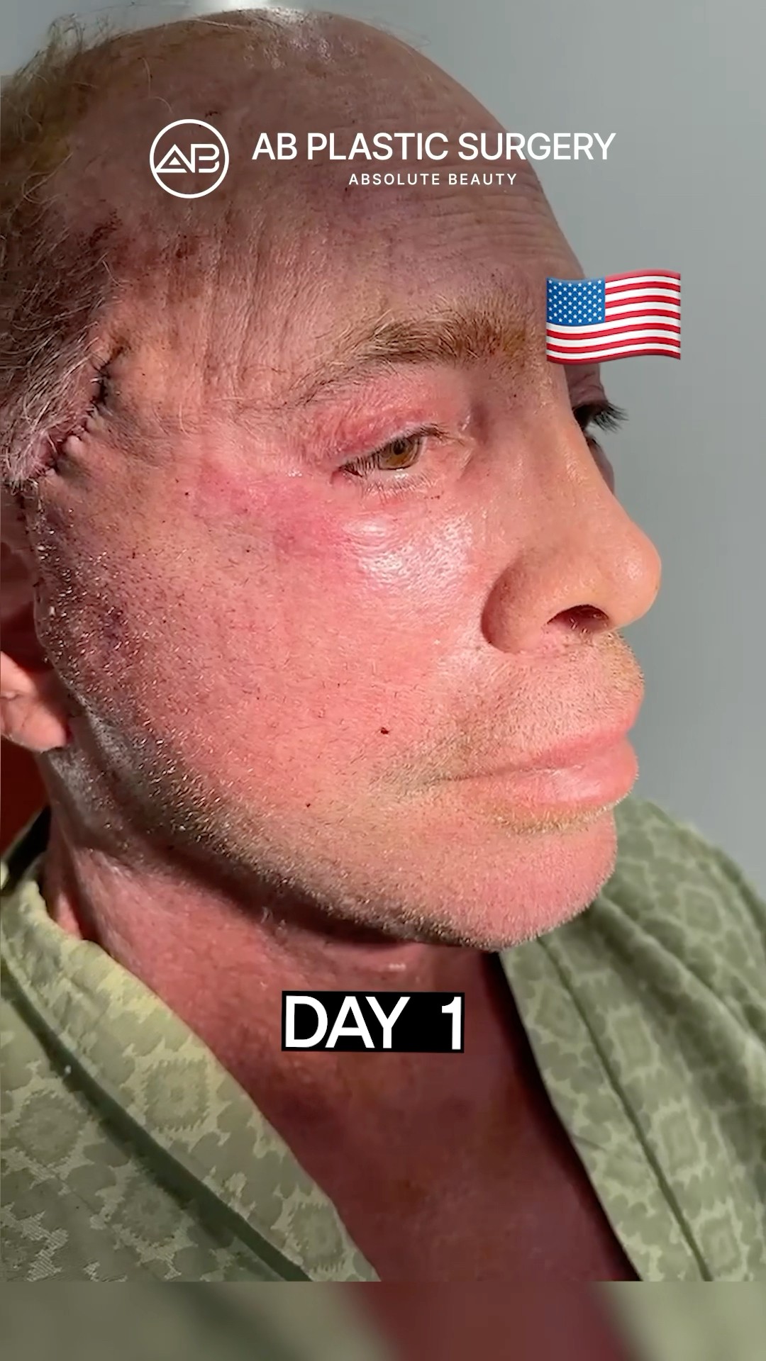 Day After My Facelift in Korea #koreanplasticsurgery