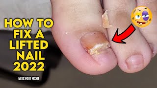 HOW TO FIX A LIFTED NAIL 2022 [ Thick Lifted Toenails] BY MISS FOOT FIXER