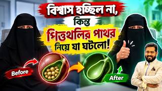 পিত্তথলির পাথর অপসারণ সার্জারি ছাড়াও কি কোনো বিকল্প আছে? আসল সত্য জানুন #GallbladderStones