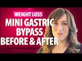 Mini Gastric Bypass Before and After - More Things I Wish I Knew