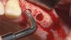 Video of  properly placing two Dental Implants on a second patient--very informative