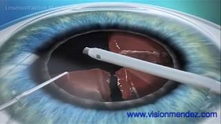 Implante De Lente Intraocular Multifocal