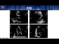 The latepresenting stemi a tale of two stemis and the importance of time