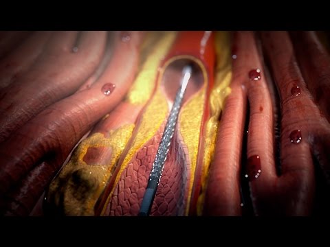 Video: 3 načina liječenja bolesti perifernih arterija