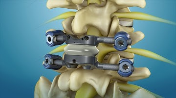 Animation of the TOPS motion device in the lumbar spine as an alternative to fusion