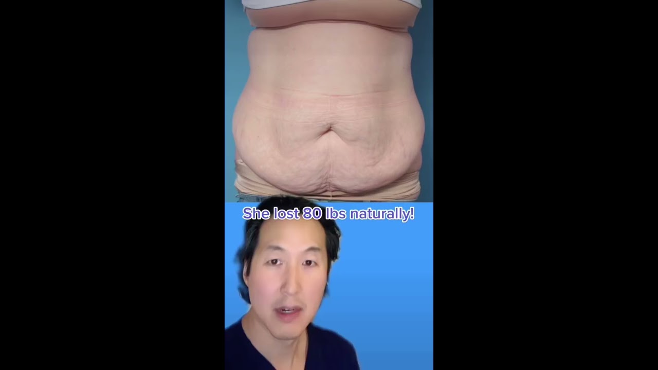 How I Remove Skin After Massive Weight Loss Shorts Abdominoplasty