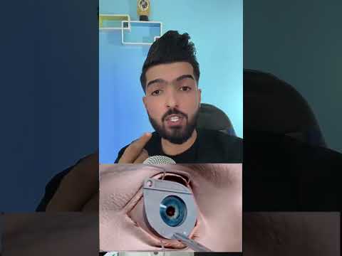 عملية الليزك 