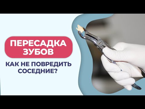 Что такое пересадка зубов? / Показания для аутотрансплантации зубов