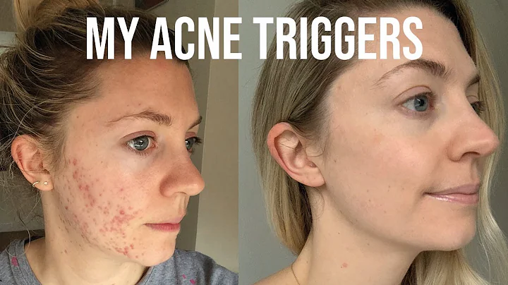 HOW I FINALLY FOUND THE ROOT CAUSE OF MY ACNE