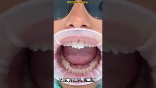 Teeth Refining?#dentosuhail#dentist #dentistry#dental#shorts#viral#subscribetomychannel