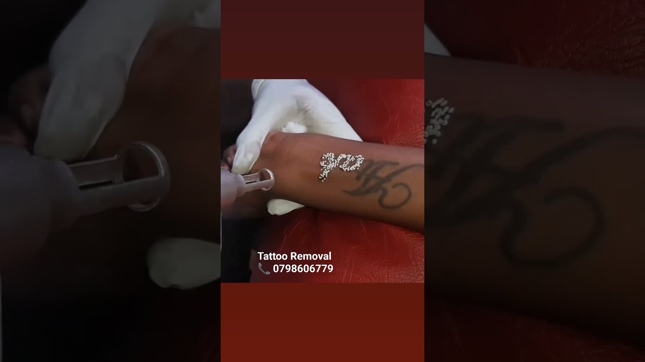 Laser Tattoo Removal In Kenya 0798606779 nairobi Laser Tattoo Removal In Kenya 0798606779 nairobi