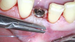 Implant uncovery and soft tissue augmentation screenshot 2