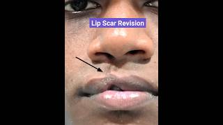 Cleft Lip Scar Revision Surgery | Lip Revision| Dr Parit Ladani