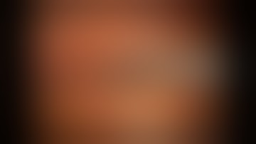 Laparoscopic right D3-hemicolectomy