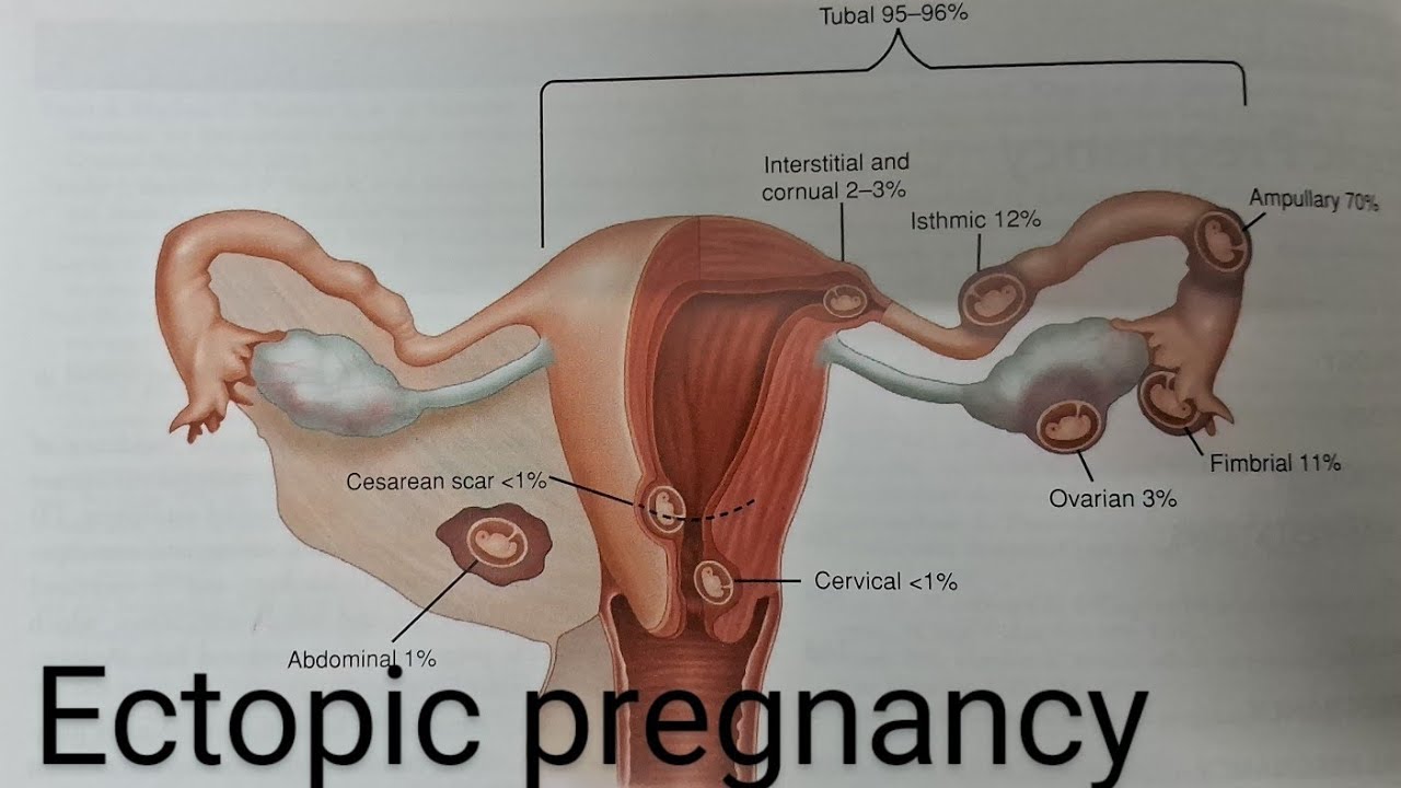 ectopic-pregnancy-signs-and-symptoms-prevention-in-kannada-youtube