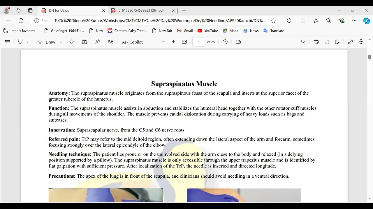 Dry Needling Intro || Indications || Contra Indications Khan || Application || Dr Dileep Kumar | CMT