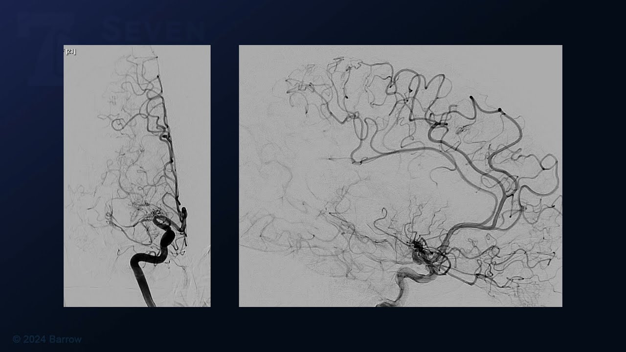 STA-MCA Bypass for Moyamoya Disease