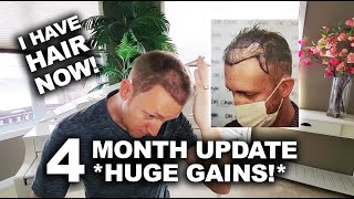 4 Month Update 3,200 Graft FUE DHI Dr. Cinik UP CLOSE Comparison Before And After Hair Transplant