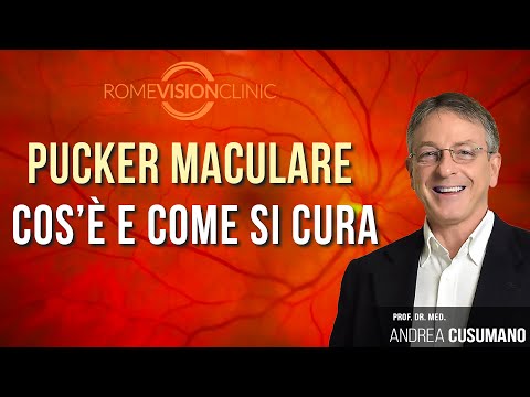 Video: Trattamento Del Foro Maculare Grande, Cronico E Persistente Con Trasposizione Interna Della Membrana Limitante E Tecnica Di Tuck