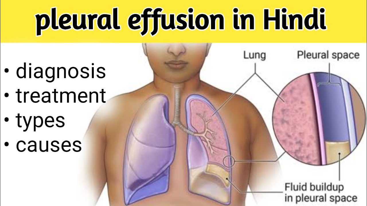 Pleural Effusion In Hindi Pleural Effusion In Hindi