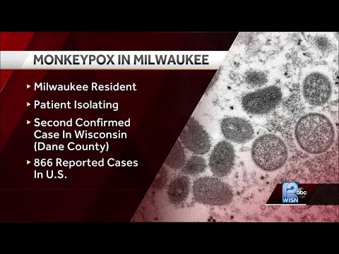 First case of monkeypox reported in city of Milwaukee