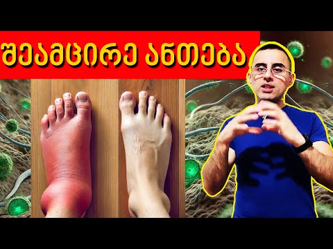 როგორ მივხვდეთ და შევამციროთ ორგანიზმში ანთება 7 გზა