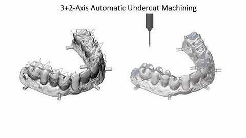 ModuleWorks Dental CAM - 3+2 Axis Automatic Undercut Finishing (Constant-Z )