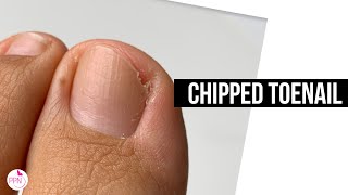 Broken Toenail Transformation At Home Using Polygel