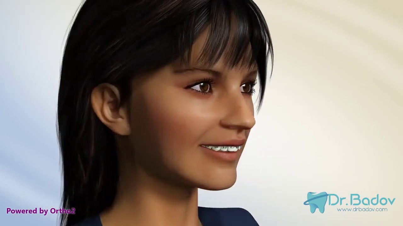 #ортодонт #брекети #детскиортодонт Ортодонтско лечение на втори скелетен клас