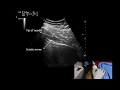 Ultrasound guided piriformis injection, by Murat Karkucak MD