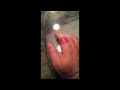 Amazing recovery from a 3rd degree burn