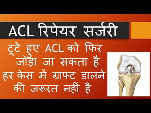 ACL Repair Surgery (Hindi). Reattachment of the torn ACL (with Internal Brace)