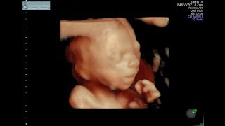 20 week ultrasound