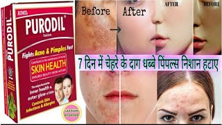 Aimil Purodil Tablets Ke Fayde Side Effects Uses Price Dosage And Review In Hindi ।। Remove Pimple
