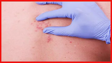 ¿Cuánto duran los dolores musculares del herpes zóster?