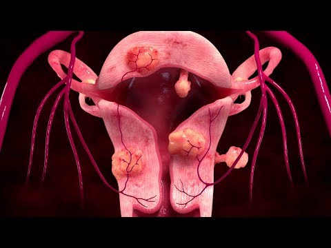uterine-fibroids-symptoms-–-causes-treatment-signs-and-symptoms-of-uterine-fibroid-tumors