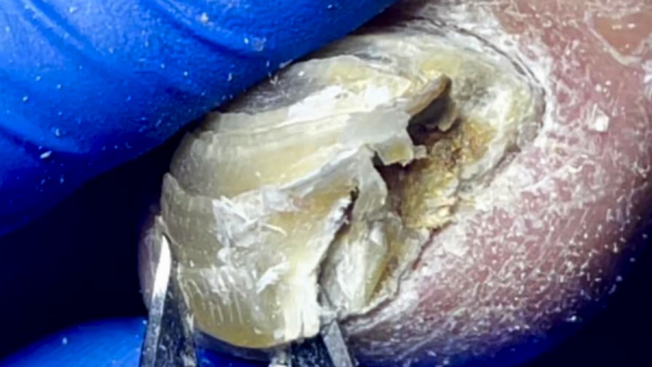 Toenails Are Cut Layer By Layer, Like Shells~【Pedicure Master Lin Jun ...