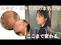 【絶対に見て】治療なしでニキビ・ニキビ跡を治した方法👹本気の肌荒れ改善。