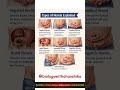 Know the types, spot the signs, protect your health. #hernias #types #healthawareness #neet
