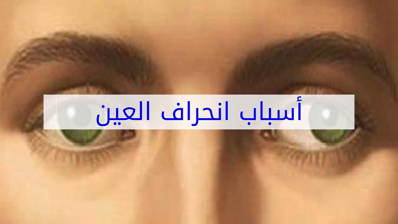 علاج الحول العين أو انحراف العين Strabismus مستشفى علاج العيون في ايران طب توب