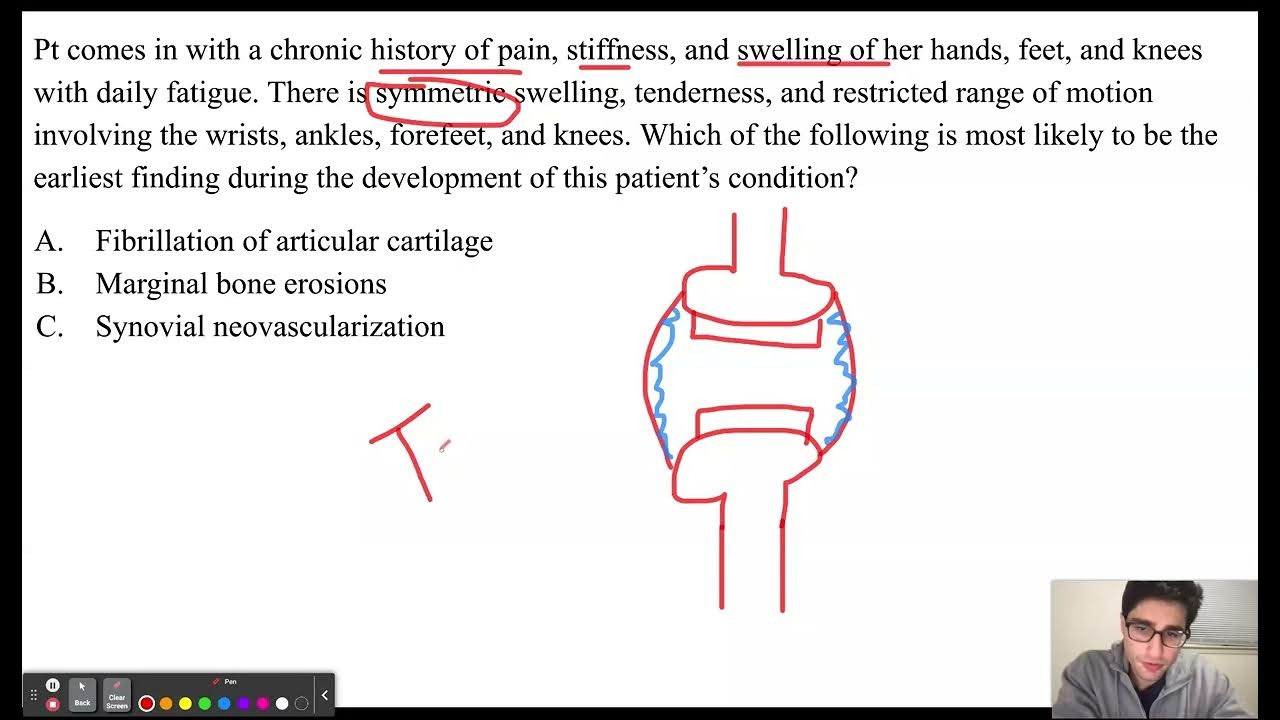 USMLE Step 1 Question of the Day 17; Rheumatoid Arthritis YouTube