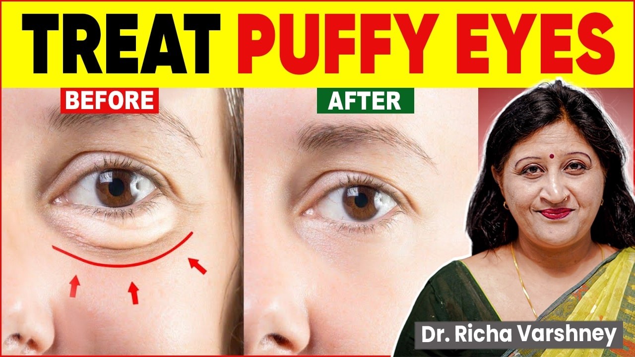 How To Cure Under Eye Bags | Puffy Eyes Home Remedies
