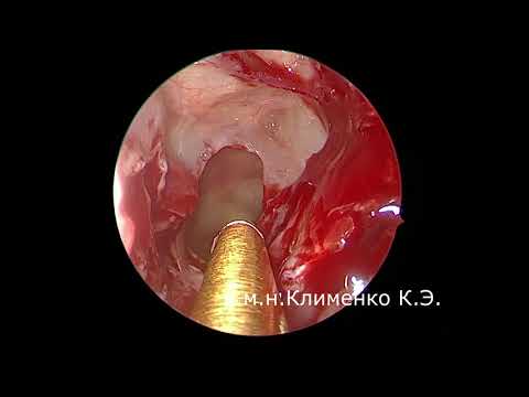 Эндоскопическая операция на верхнечелюстной, решетчатых, клиновидной пазухах: шаг за шагом
